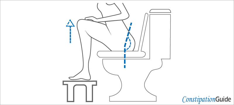A person is sitting on the toilet bowl using a low-rise footstool and perfect anorectal angle.