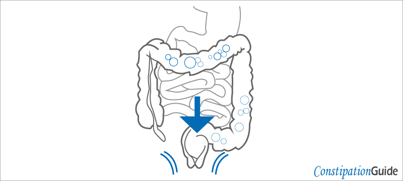 The illustration of the abdomen and intestines shows the squeezing of the rectum.