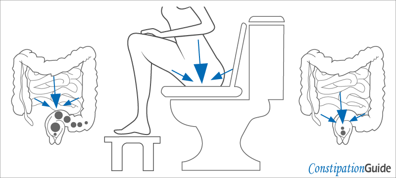 The image depicts a person sitting on a toilet bowl, gently pushing and squeezing the rectum to facilitate smooth defecation.