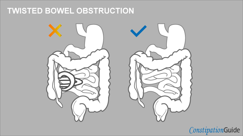 The illustration shows a twisted bowel obstruction of the small intestine without too many details and a normal state.